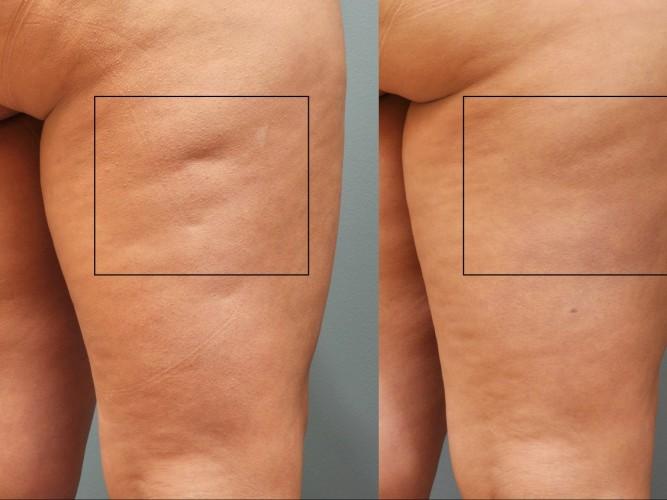 Cellulaze Michigan  Accents Cosmetic Surgery