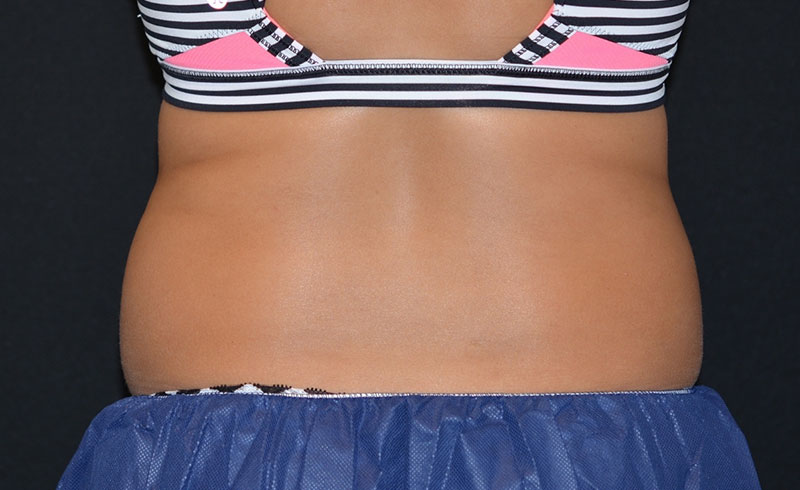 Coolsculpting Female Love Handles Before And After