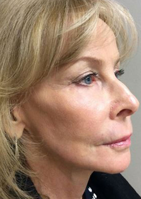 Laser Resurfacing Before and After 07
