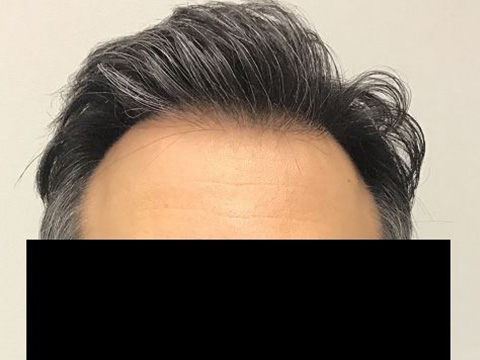 Neograft For Men Before and After 16