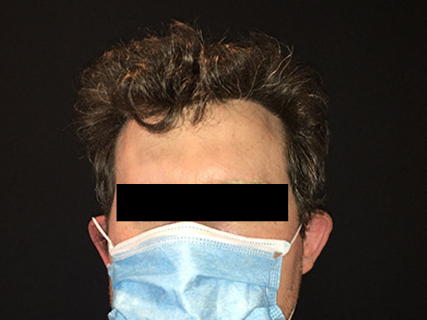 Neograft For Men Before and After 17