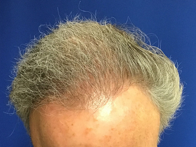 Neograft For Men Before and After 16