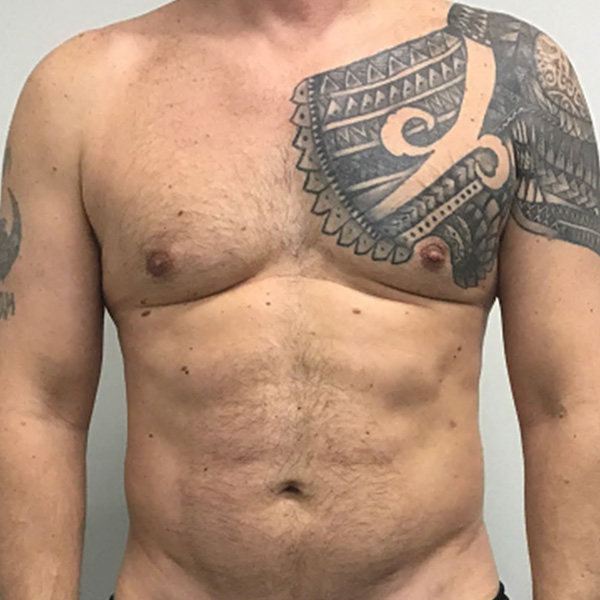Vaser Lipo Before and After 01